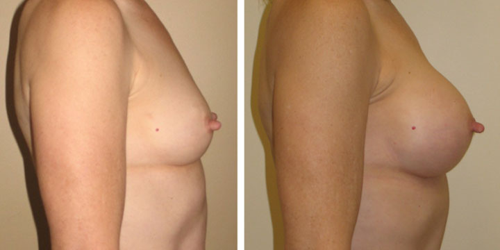 Breast Augmentation after Breast Feeding