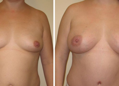 Breast Augmentation to Increase Cleavage