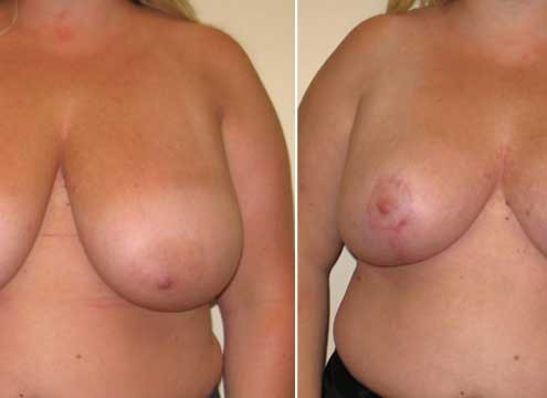 Breast Lift Before & After Photo