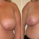 Breast Lift Before & After Photo