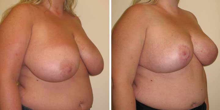 Breast Lift Before & After Photo