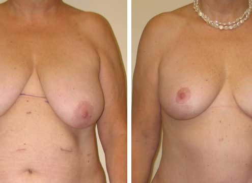 Breast Lift After Weight Loss