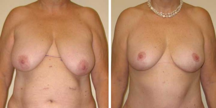 Breast Lift After Weight Loss