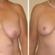 Breast Lift After Weight Loss