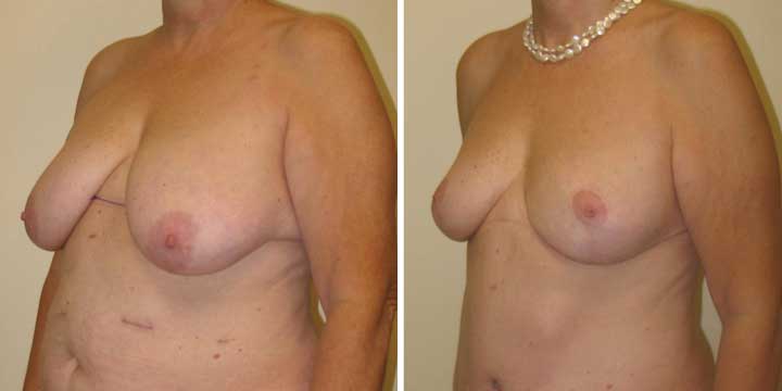 Breast Lift After Weight Loss