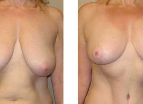 Breast Lift after weight loss