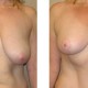 Breast Lift after weight loss