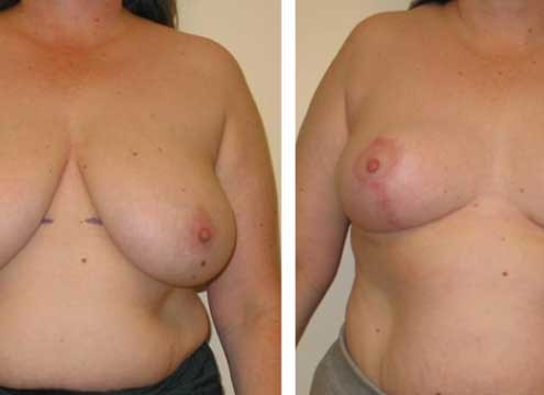 Breast Lift / Breast Reduction before and after photo