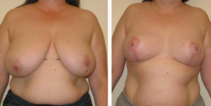 Breast Lift / Breast Reduction before and after photo