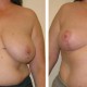 Breast Lift / Breast Reduction before and after photo
