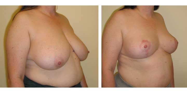 Breast Lift / Breast Reduction before and after photo
