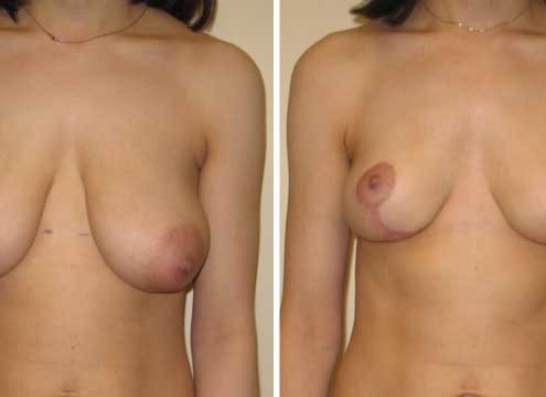 Breast Lift photo before and after