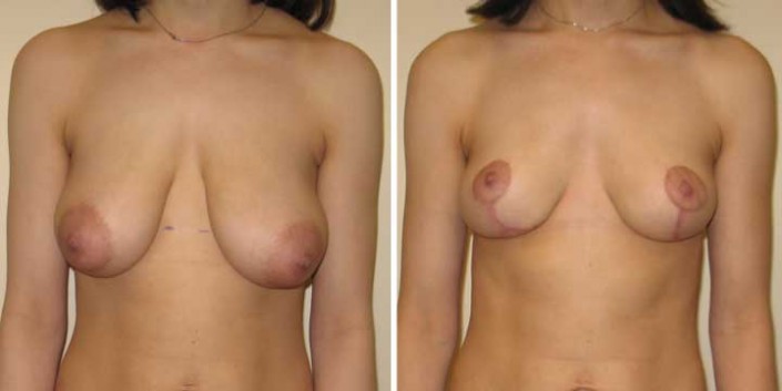 Breast Lift photo before and after