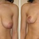 Breast Lift photo before and after