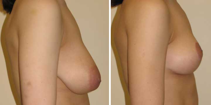 Breast Lift photo before and after