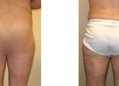 Liposuction on thighs