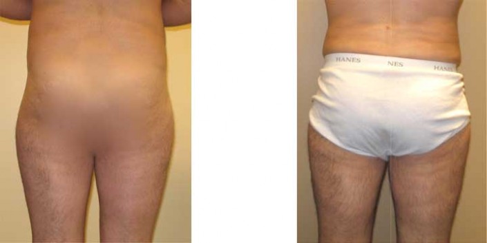 Liposuction on thighs