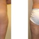Liposuction on thighs