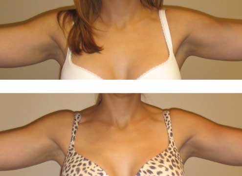 Liposuction on arms