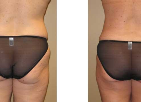 Liposuction before and after comparison