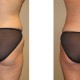 Liposuction before and after comparison