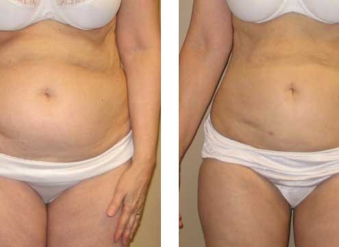 Liposuction Before and After Pictures