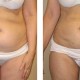 Liposuction Before and After Pictures