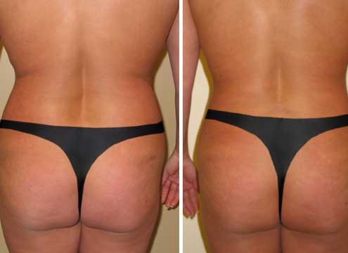 Liposuction of love handles