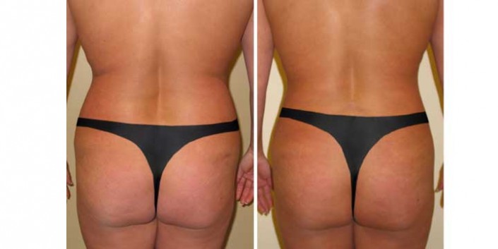 Liposuction of love handles