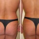 Liposuction of love handles