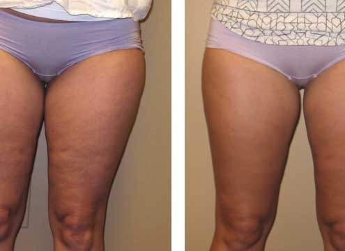Liposuction of outer thighs