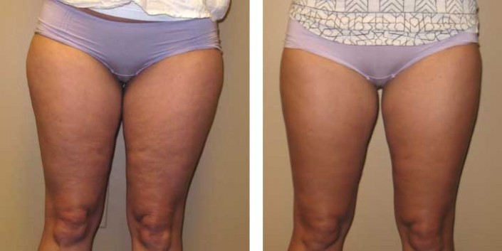 Liposuction of outer thighs