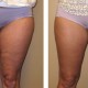 Liposuction of outer thighs