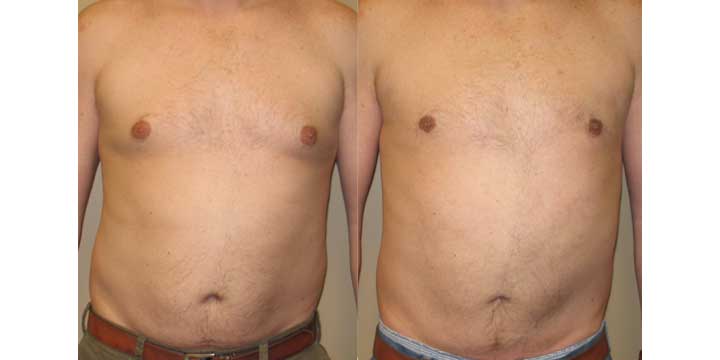 Ultrasonic Assisted Liposuction