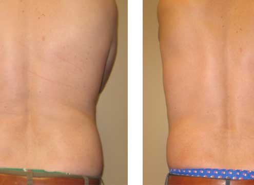 Ultrasonic Assisted Liposuction