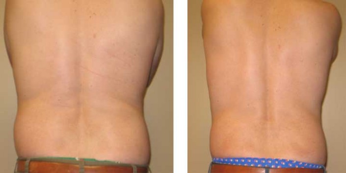 Ultrasonic Assisted Liposuction