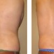 Ultrasonic Assisted Liposuction