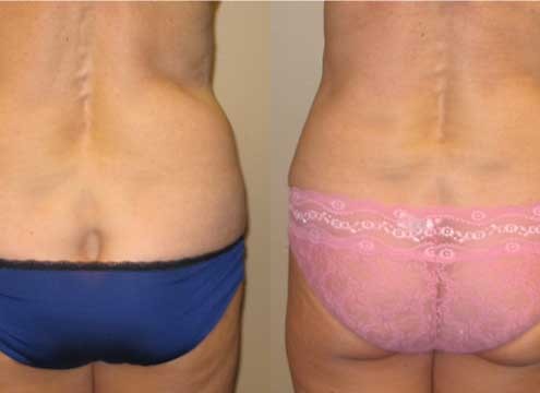 Liposuction of muffintops