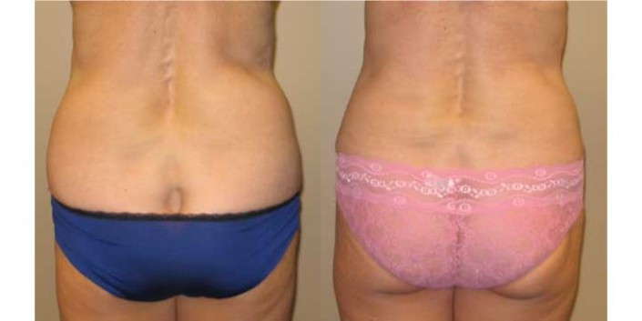 Liposuction of muffintops