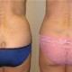 Liposuction of muffintops