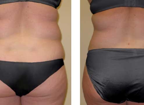 Liposuction of love handles and muffintops