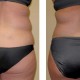 Liposuction of love handles and muffintops