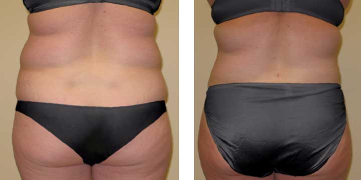 Liposuction of love handles and muffintops