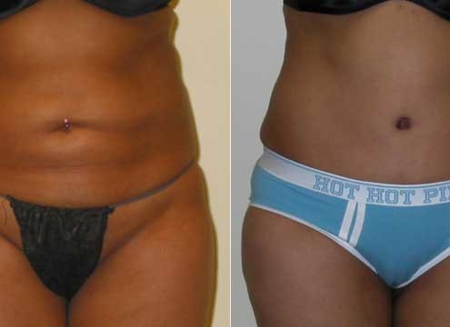 Liposuction of inner & outer thighs
