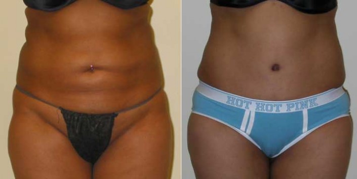 Liposuction of inner & outer thighs