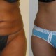 Liposuction of inner & outer thighs