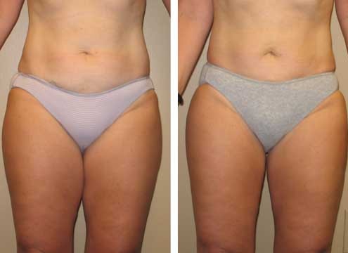 Liposuction Before and After Images