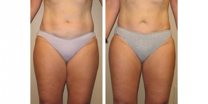 Liposuction Before and After Images