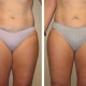 Liposuction Before and After Images