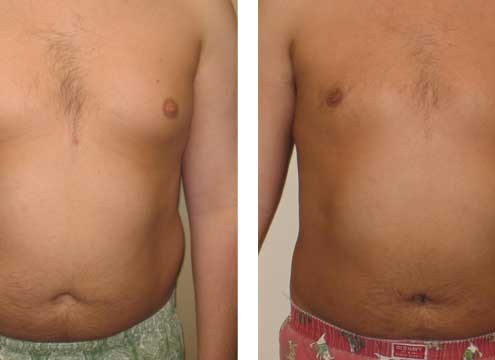 Liposuction Before & After Photos